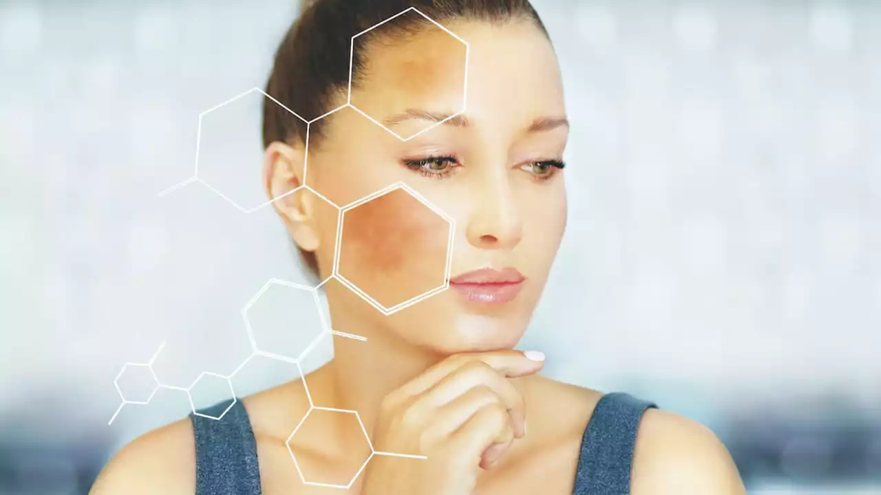 Melasma and Gut Health: Is There a Connection?